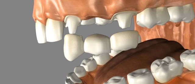 Dental Bridge