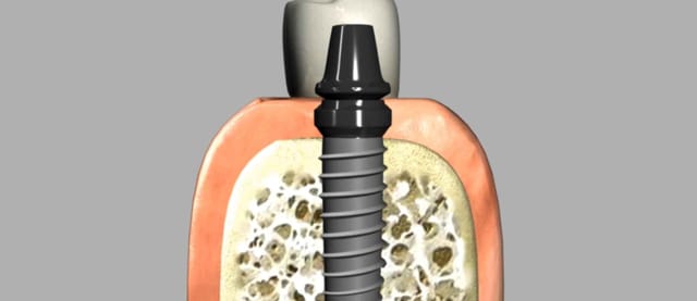 Dental Implants
