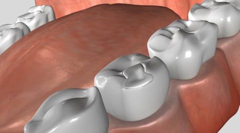 Dental Inlays & Onlays Dental Inlays & Onlays