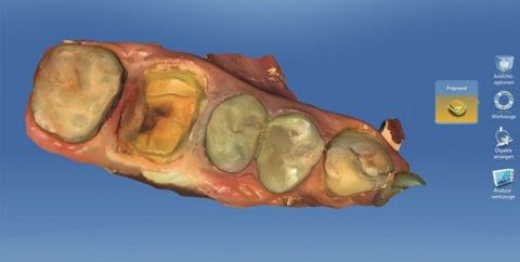 CEREC CAD Unit Showing Restoration Areat CEREC CAD Unit Showing Restoration Area